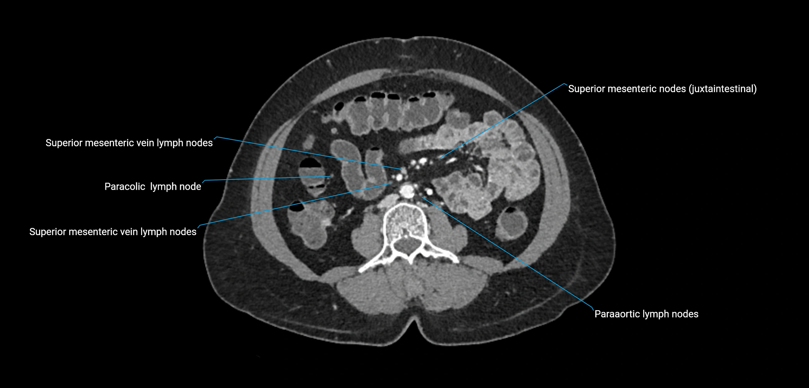 CT ct abdominal lymph nodes  axial cross sectional anatomy  enchanced radiology image -img-00002-00237.webp